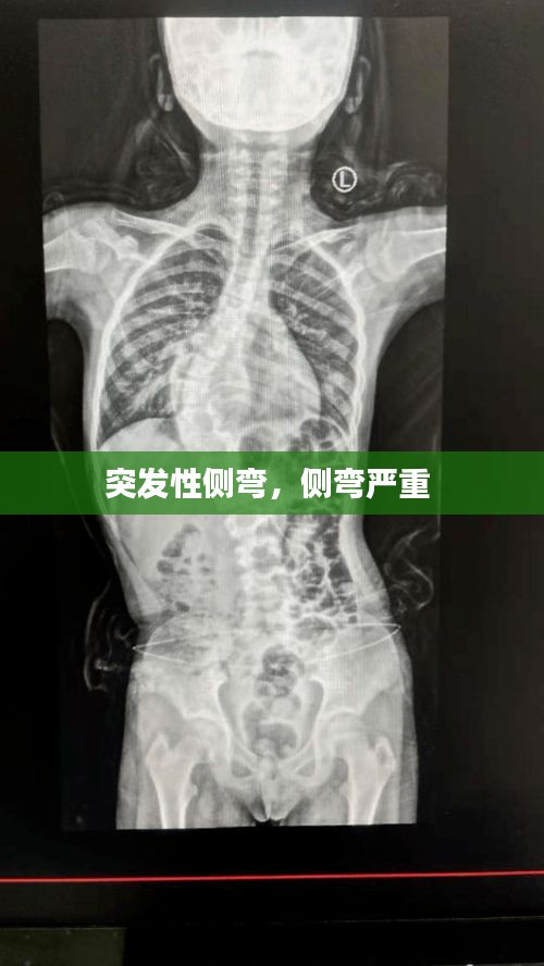 突发性侧弯，侧弯严重 
