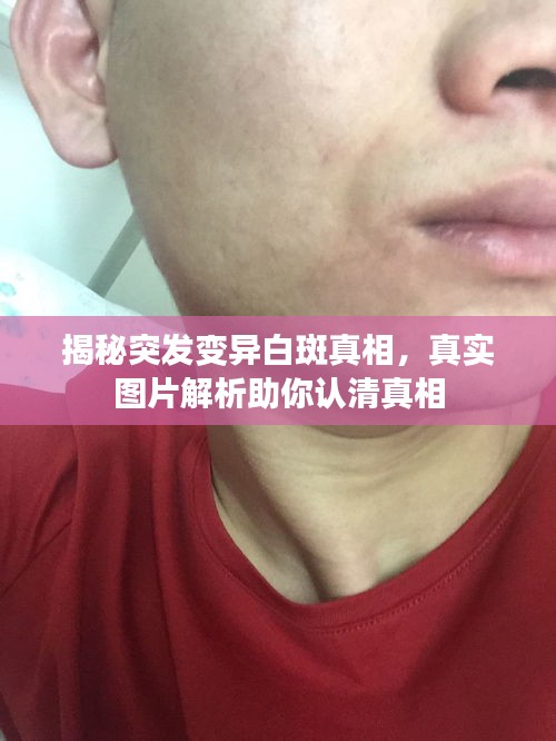揭秘突发变异白斑真相，真实图片解析助你认清真相